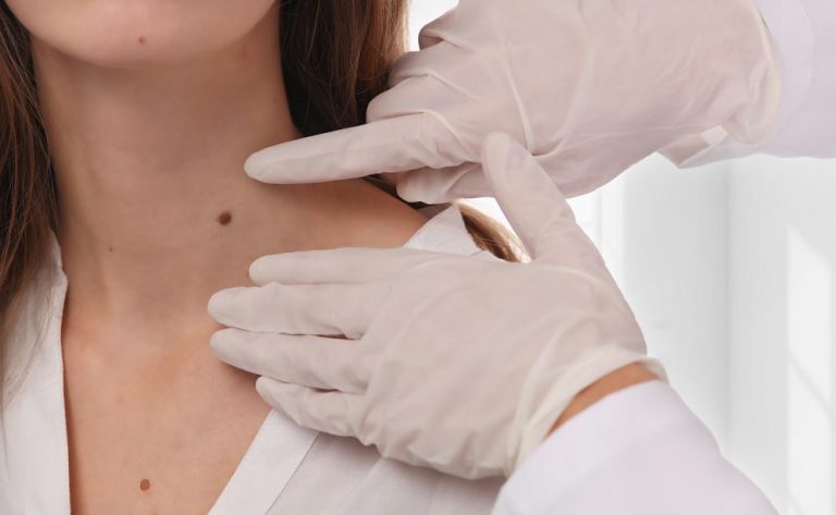Close-up of skin tag removal procedure on neck area by dermatologist in Birmingham